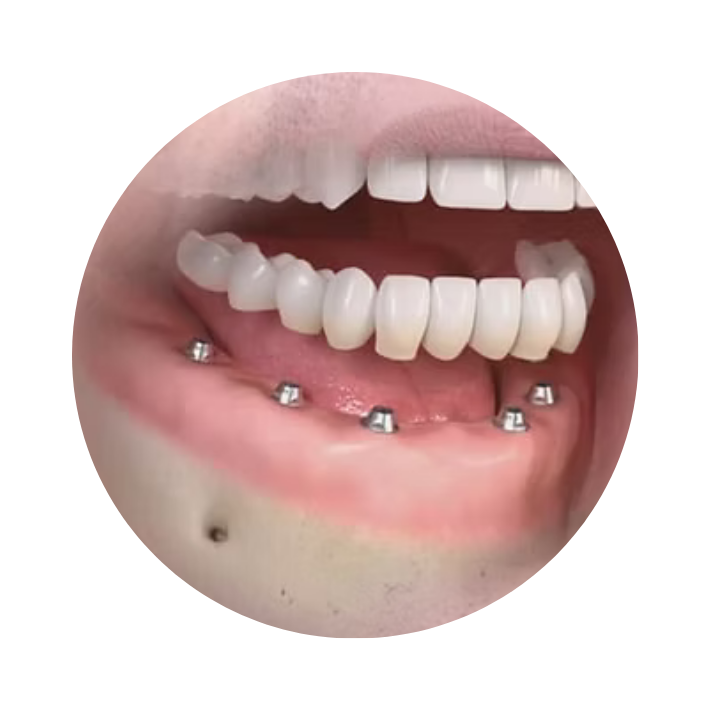 implante-dentario-dra-sandra-miranda